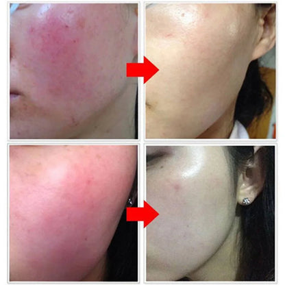 7 Day Repair Redness Serum Sooth Itching Sensitive Skin Improve Rosacea Shrink Pore Smooth Nourish Facial Skin Korean Cosmetics