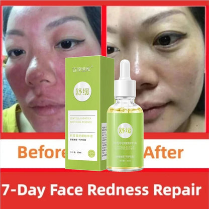7 Day Repair Redness Serum Sooth Itching Sensitive Skin Improve Rosacea Shrink Pore Smooth Nourish Facial Skin Korean Cosmetics